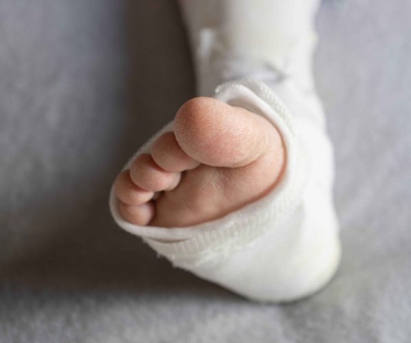 Achilles Tendon Repair