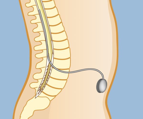 Intrathecal Drug Delivery (Pain Pumps)