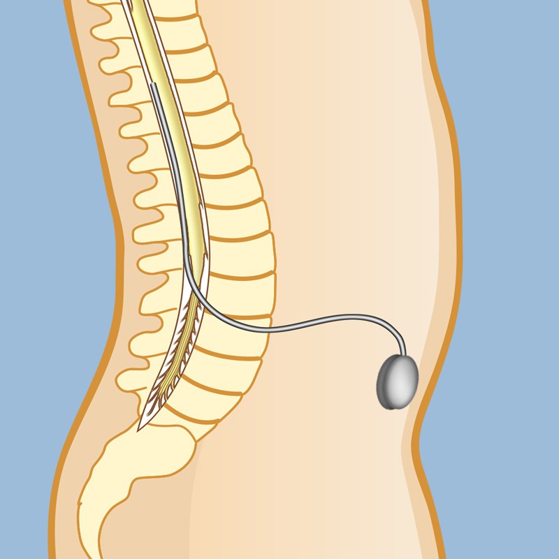 Intrathecal drug delivery (pain pumps)