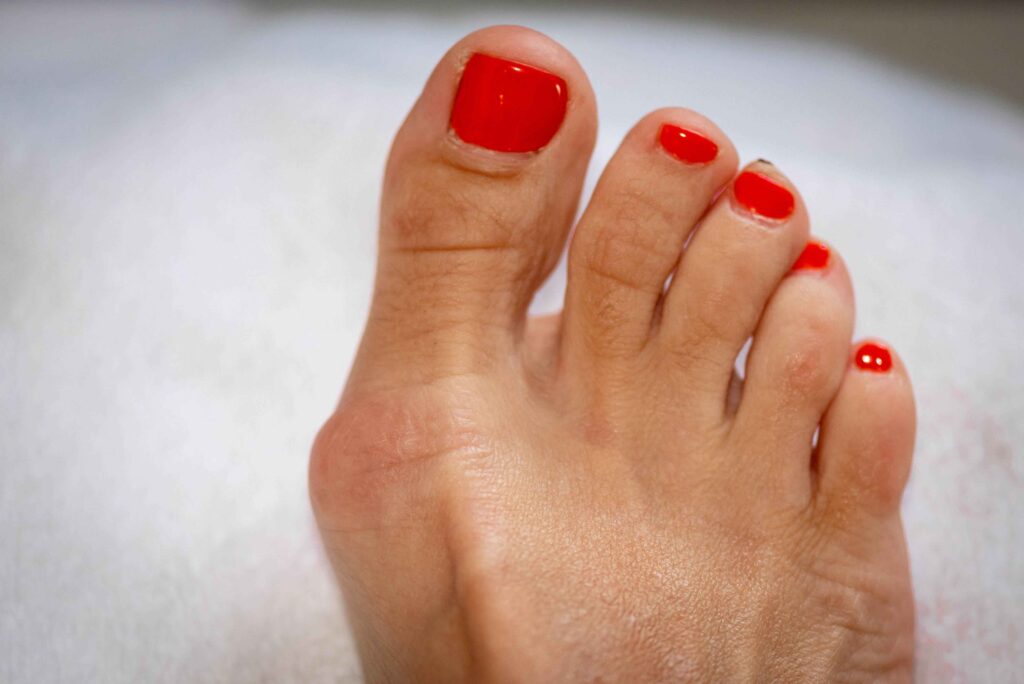 Bunion surgery (bunionectomy) 8 Surgical correction of hallux valgus deformity of the big toe