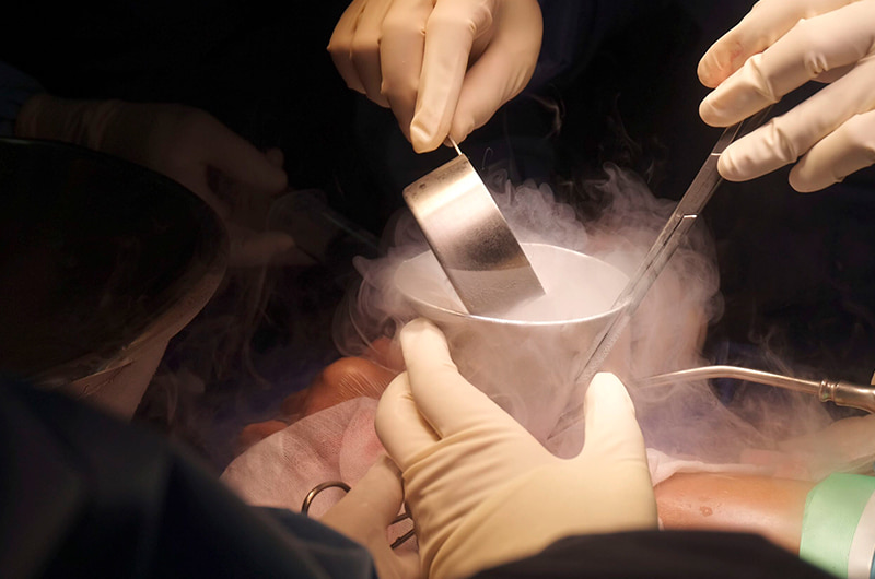 Cryosurgery 1 Cryosurgery