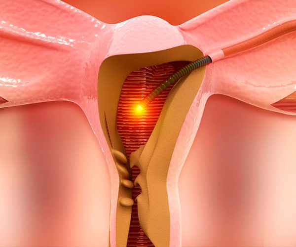 Dilation-and-Curettage-DC-scaled-1 Dilation-and-Curettage-DC