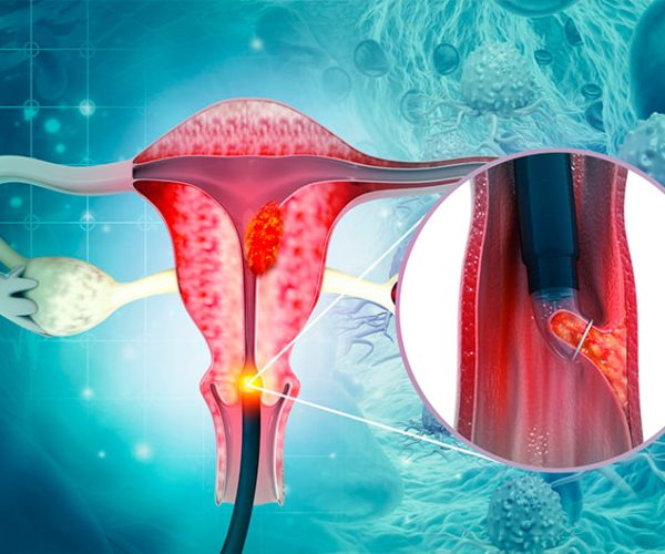 Endometrial-Biopsy-scaled