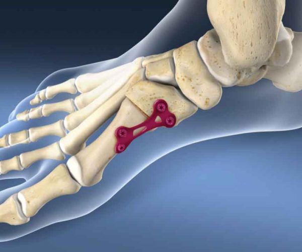 Permanent joining of bones to stabilize painful or arthritic foot joints.
