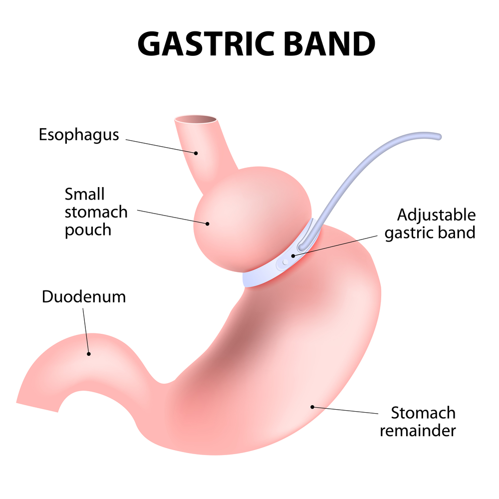 Gastric band surgery