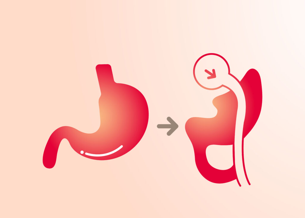 Gastric bypass surgery (roux-en-y gastric bypass)