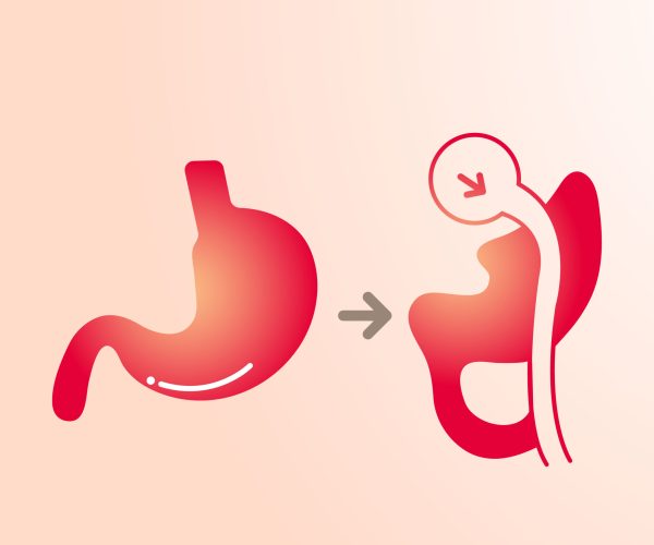 Gastric Bypass Surgery (Roux-en-Y Gastric Bypass)