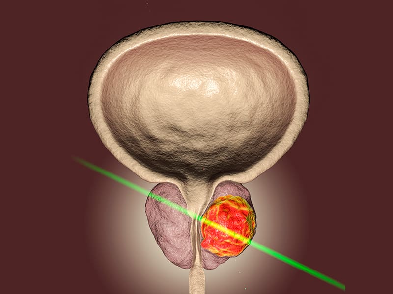 Greenlight laser therapy 2 Greenlight laser therapy