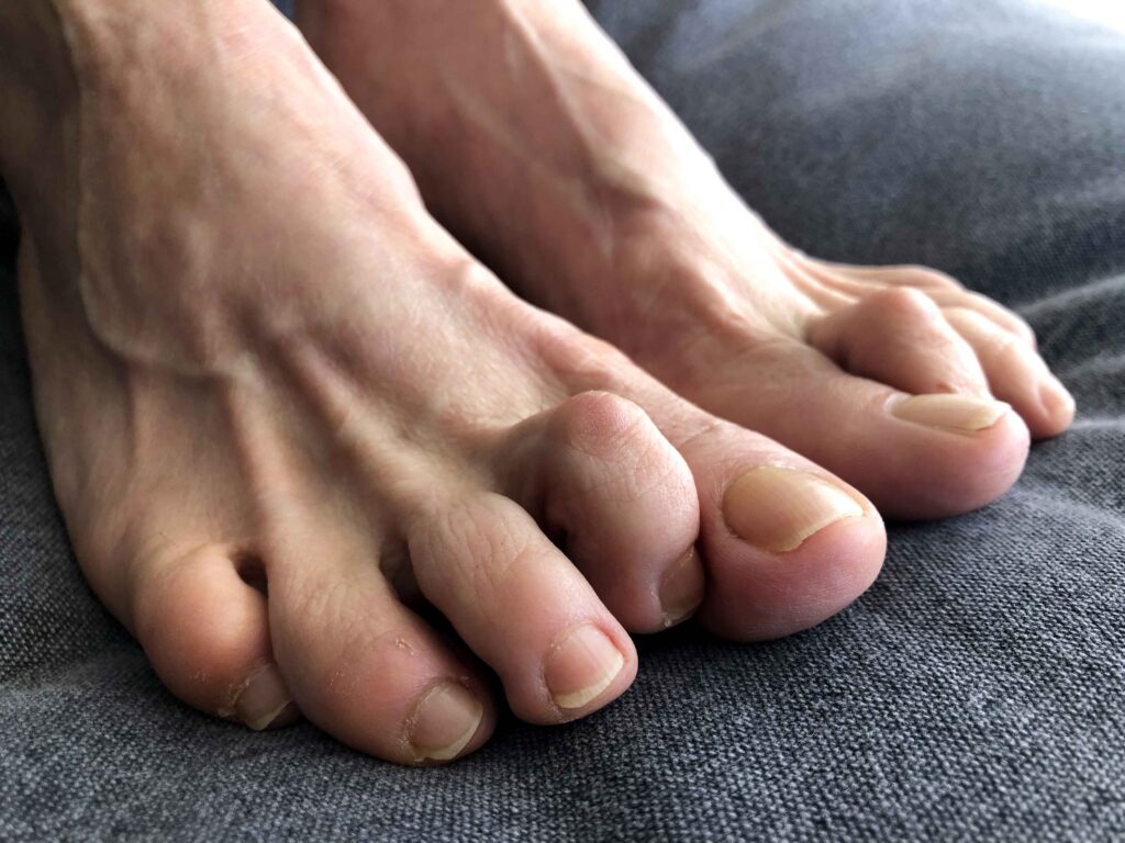 Straightening of curled toes to relieve pain and improve alignment.