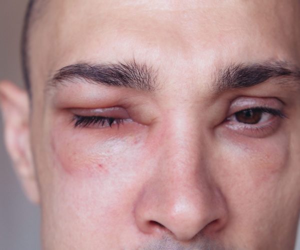 Insect Allergies (Venom)