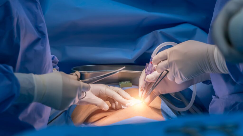 Laparoscopic surgery 7 Laparoscopic surgery