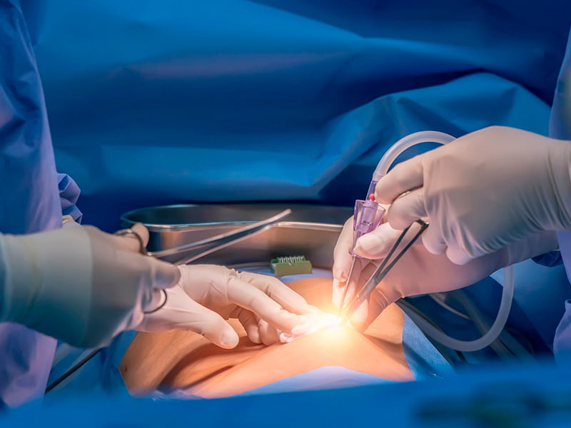 Laparoscopy 9 Laparoscopy