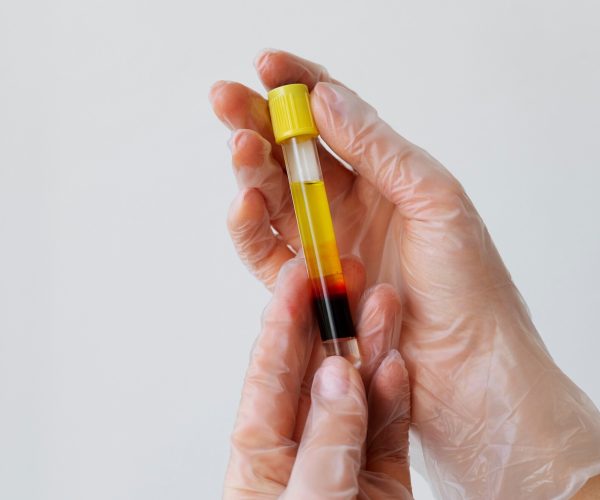 Plasmapheresis Plasmapheresis