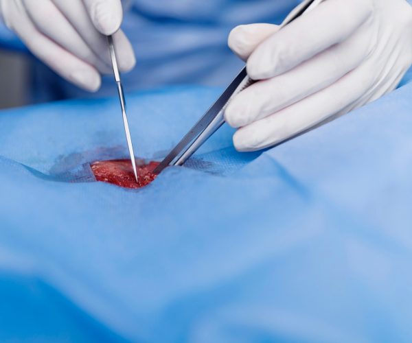 Percutaneous Native Kidney Biopsy