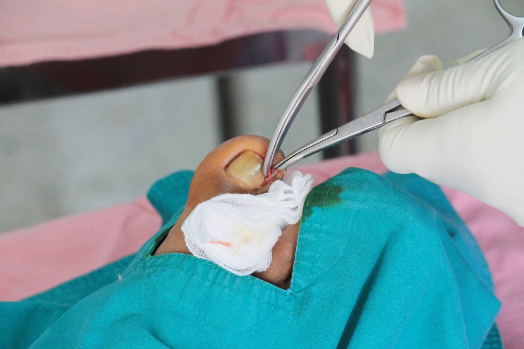 Removal of part or all of a toenail to relieve pain or infection.