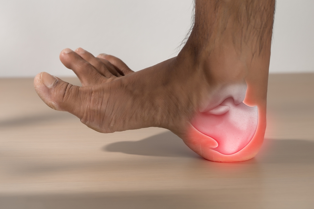 Foot with visible pain and inflammation in the heel area, indicating plantar fasciitis.