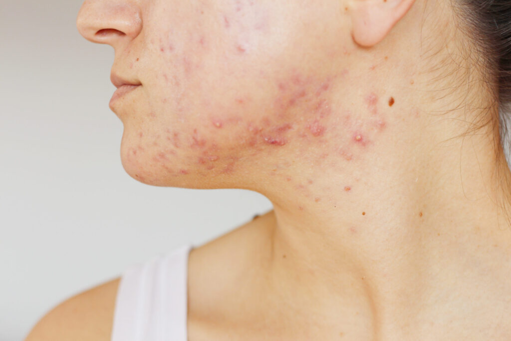 Acne and breakout management 4 Severe acne
