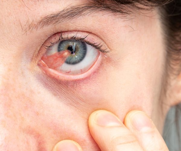 Pterygium Surgery (Eye) Pterygium Surgery