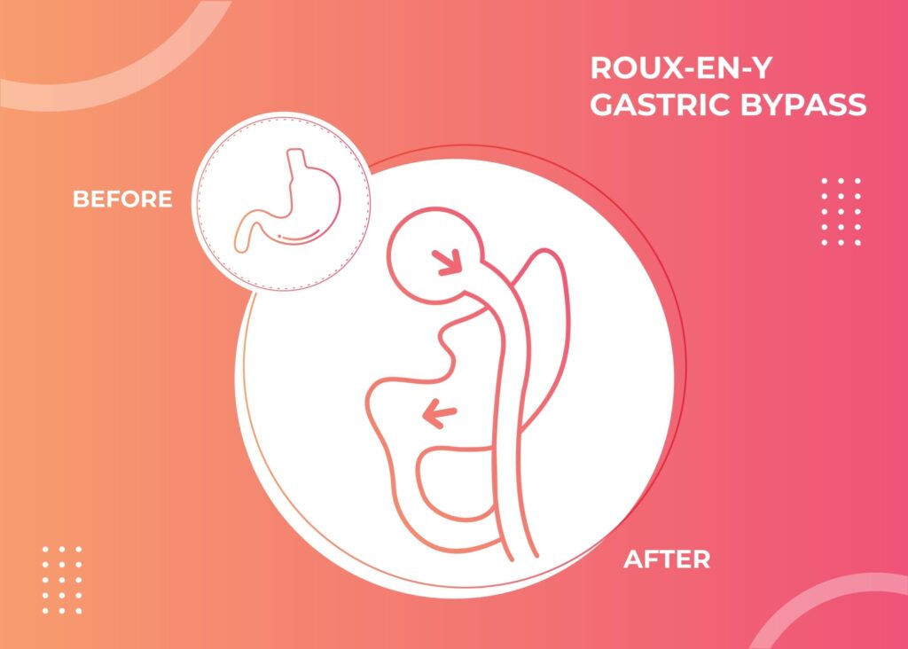 How roux-en-y bypass surgery is performed 1 Roux-en-y gastric bypass surgery