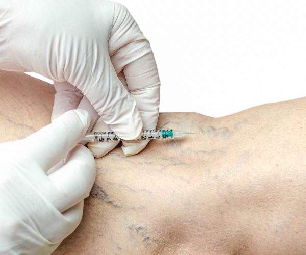 A minimally invasive treatment to reduce spider veins and small varicose veins. Sclerotherapy