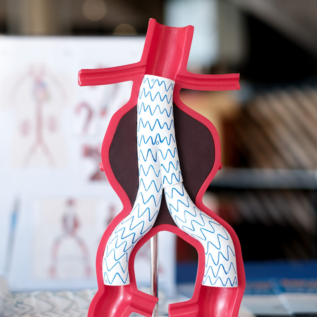 Endovascular aneurysm repair (evar)