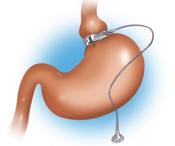 Gastric Banding