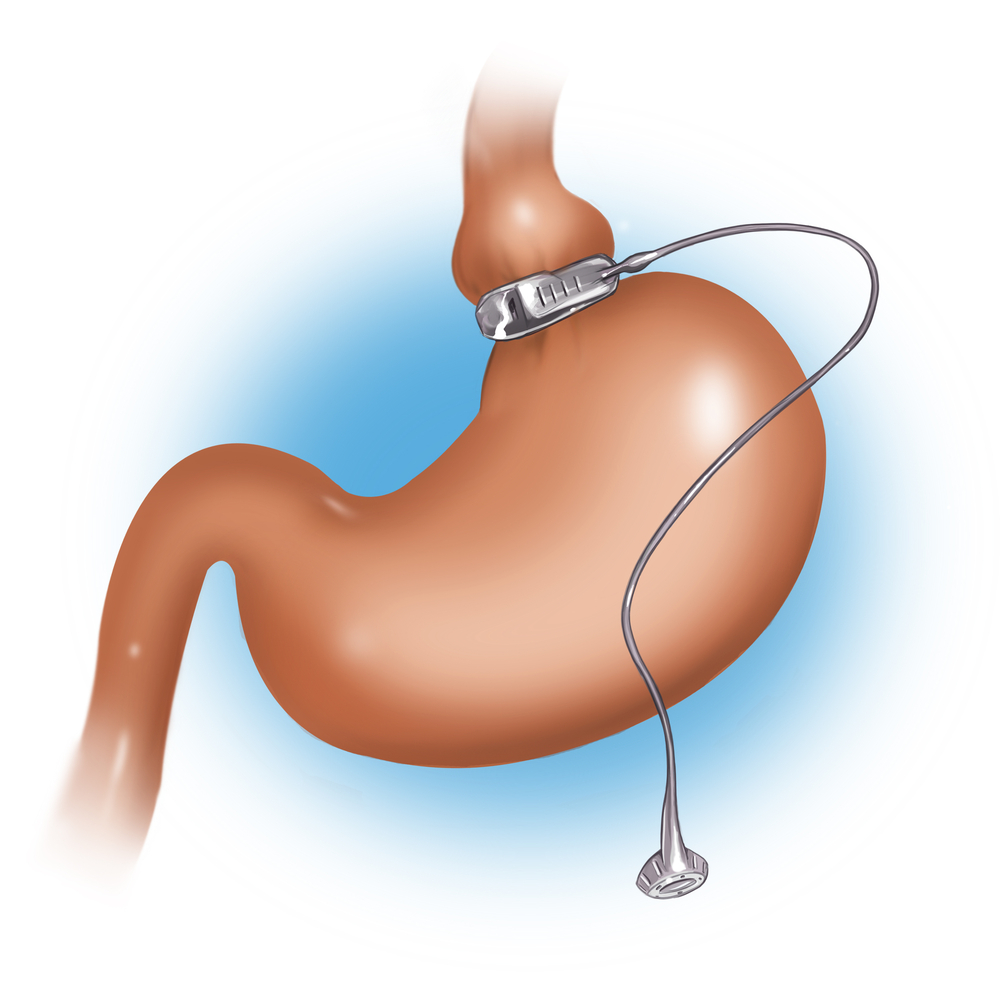 Gastric banding
