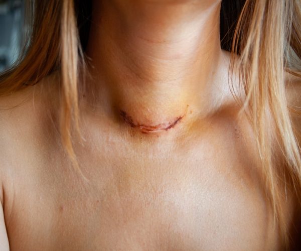 Endoscopic Thyroidectomy