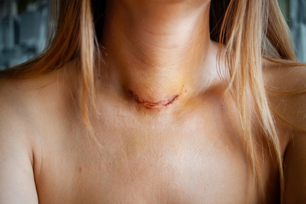 Endoscopic thyroidectomy 9 Endoscopic thyroidectomy