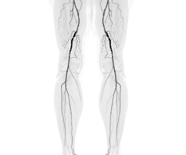 Peripheral Artery Disease (PAD) Treatment