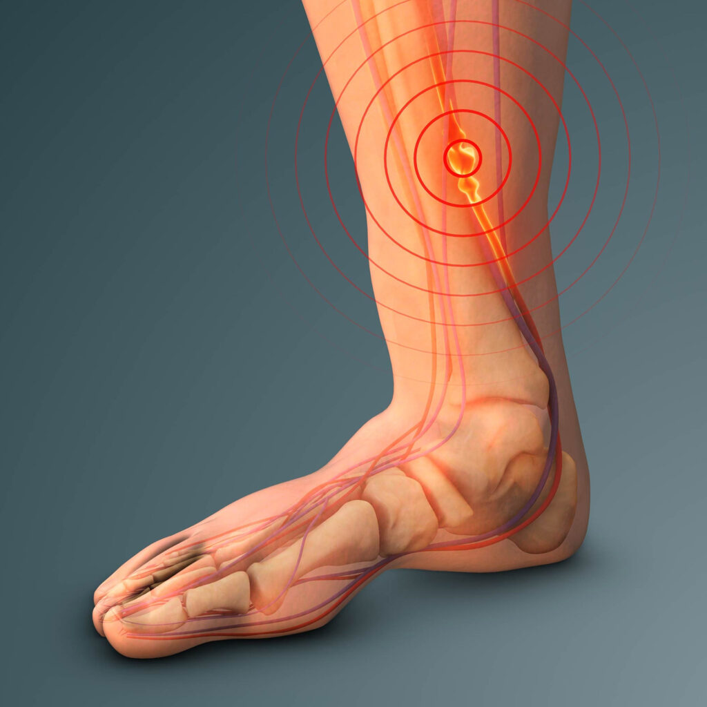 Deep vein thrombosis (dvt) treatment