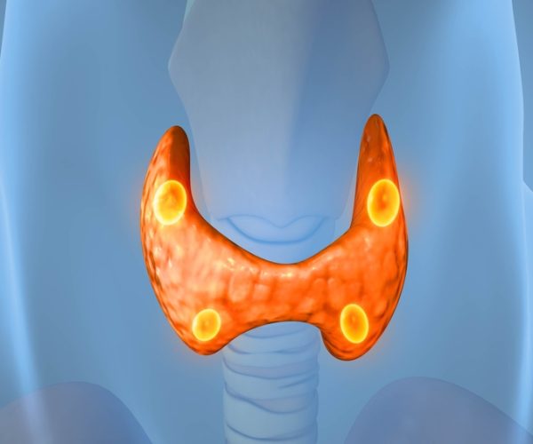 Parathyroidectomy Minimally Invasive Parathyroidectomy (MIP)