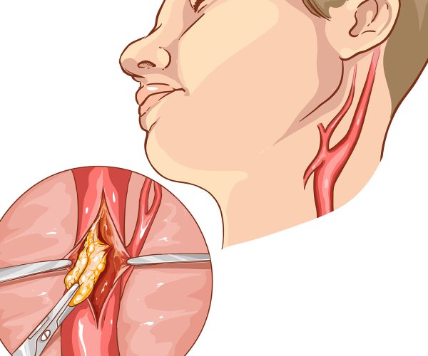 Carotid Endarterectomy Carotid Endarterectomy