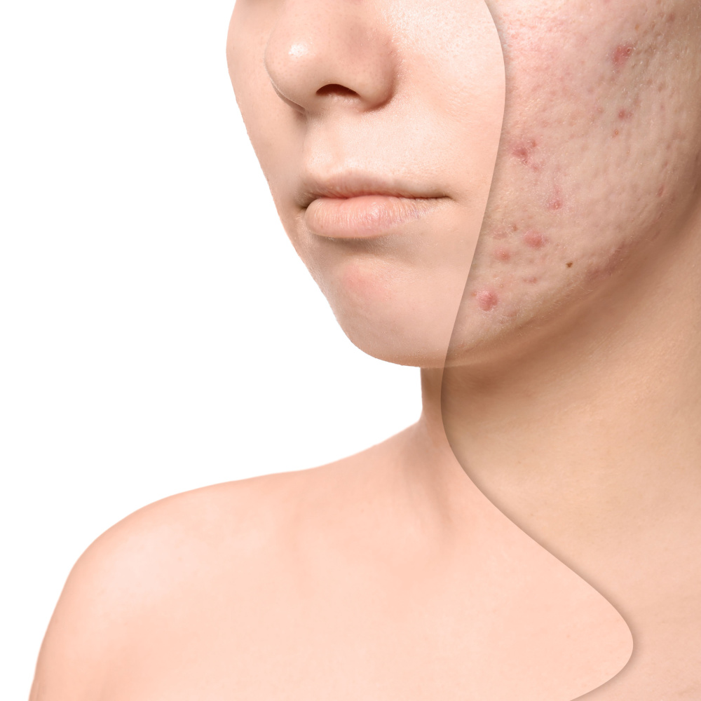 Understanding and treating acne scars: 10 effective solutions for clearer skin 1 Acne scars