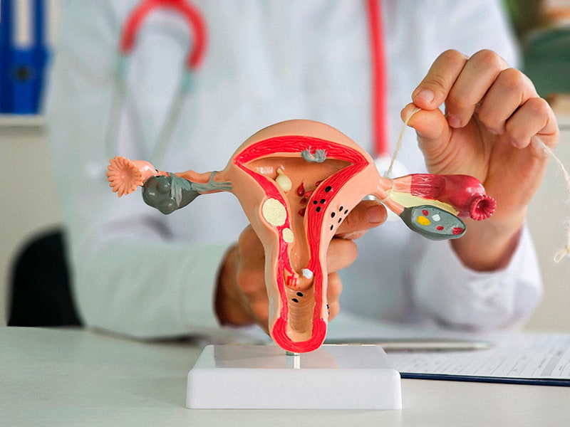 Tubal ligation 5 Tubal-ligation