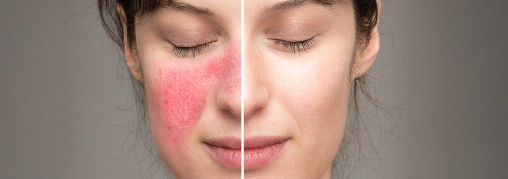 Rosacea 2 Rosacea