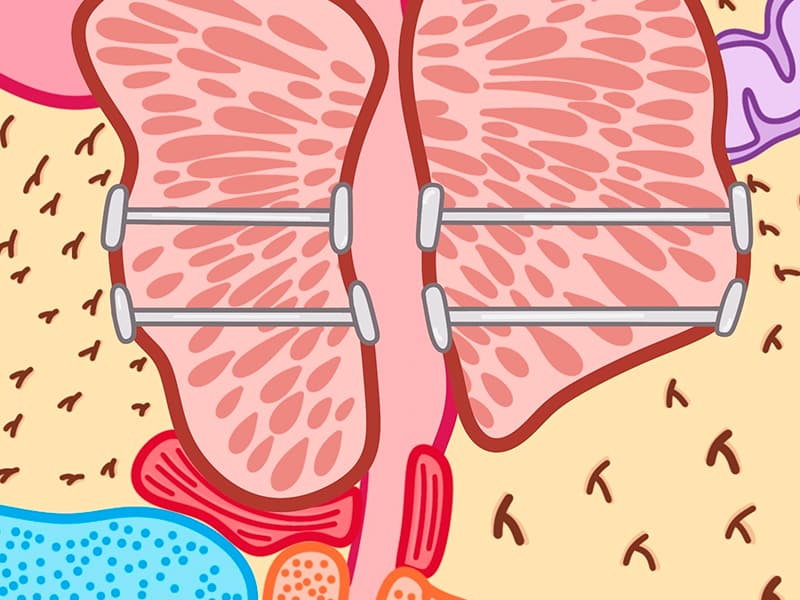 Urolift system 3 Urolift system