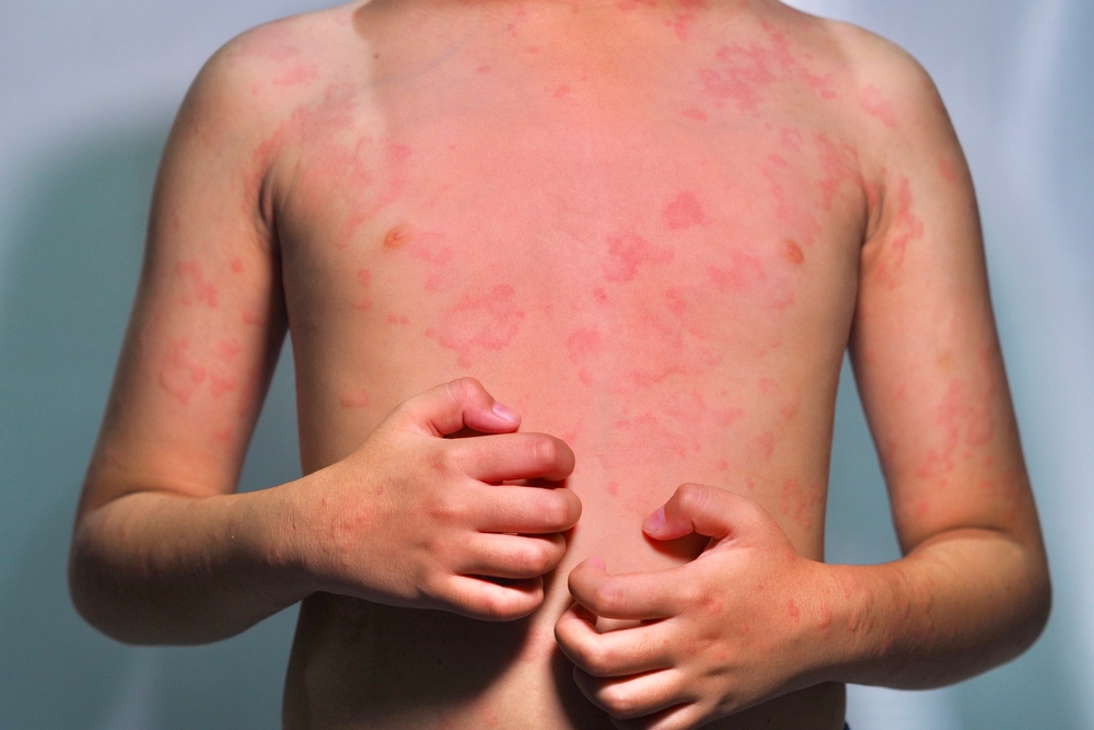 hives Urticaria