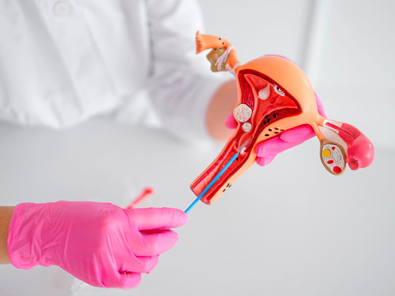 Uterine biopsy 4 Uterine-biopsy