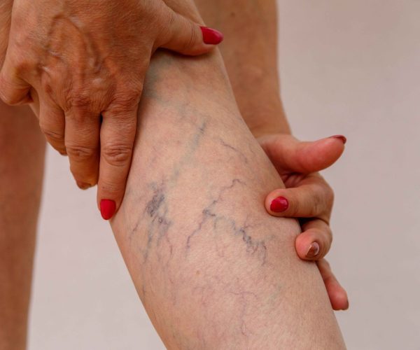Varicose Vein Treatment Varicose Vein Treatment