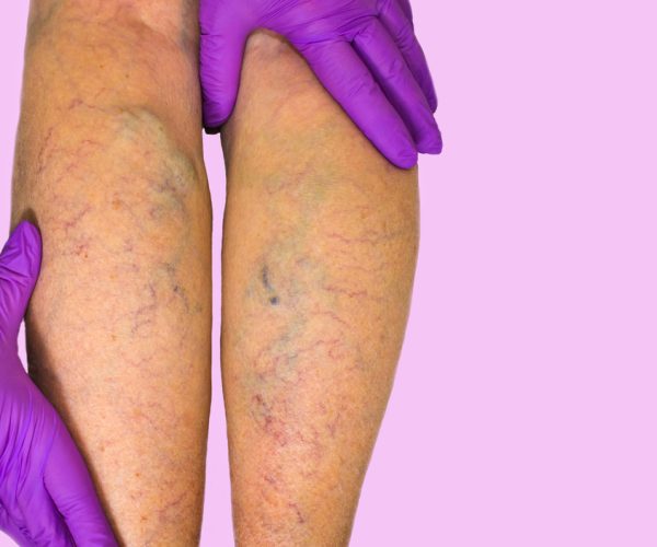 Venous Insufficiency Treatment